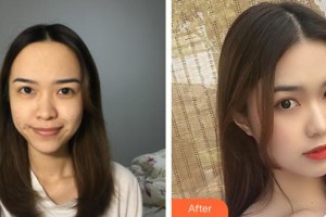 石家莊雍禾植發(fā)醫(yī)院韓巖整形價(jià)格表附種植發(fā)際線案例展示