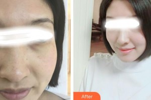 石家莊巍名仕醫(yī)療美容醫(yī)院高興柳整形價(jià)格表附美白嫩膚案例展示