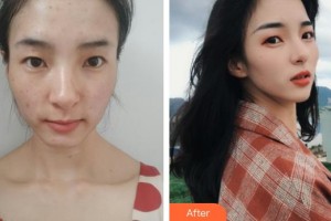 石家莊樂仁堂萬瑞醫(yī)療美容門診部曾明禮整形價(jià)格表附清潔祛痘案例展示