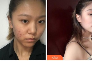 石家莊雅芳亞醫(yī)療美容醫(yī)院吳小玉整形價(jià)格表附鼻部綜合案例展示