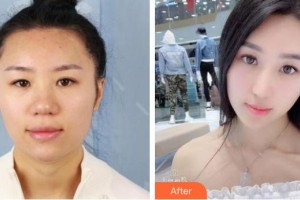 石家莊雅芳亞醫(yī)療美容醫(yī)院張雪梅整形價(jià)格表附肋軟骨隆鼻案例展示