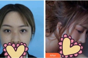 石家莊壹零壹華擎醫(yī)療美容醫(yī)院唐麗金整形價(jià)格表附鼻部綜合案例展示