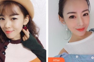 石家莊美萊醫(yī)學(xué)美容醫(yī)院田建輝整形價(jià)格表附假體隆鼻案例展示