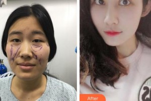 石家莊美萊醫(yī)學(xué)美容醫(yī)院姜濤整形價(jià)格表附鼻部綜合案例展示