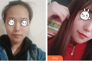 石家莊越然醫(yī)療美容門診部王寶琦整形價(jià)格表附光子嫩膚案例展示