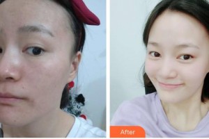 石家莊美萊醫(yī)學(xué)美容醫(yī)院王亮整形價(jià)格表附去痘印痘坑案例展示