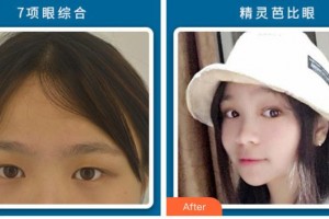 石家莊艾麥德醫(yī)療美容門(mén)診部王秀紅整形價(jià)格表附切開(kāi)雙眼皮案例展示