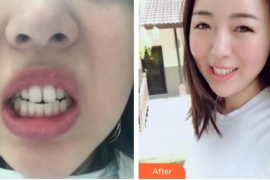 石家莊艾麥德醫(yī)療美容門(mén)診部張曉建整形價(jià)格表附隱形托槽矯正案例展示