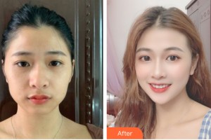 武漢蜜司醫(yī)療美容門診部楊蓉整形價格表附自體脂肪填充案例展示