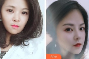 黑龍江省人民醫(yī)院整形美容中心王更整形價格表附鼻部綜合案例展示