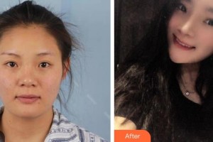 黑龍江省人民醫(yī)院整形美容中心譚志軍整形價格表附肋軟骨隆鼻案例展示