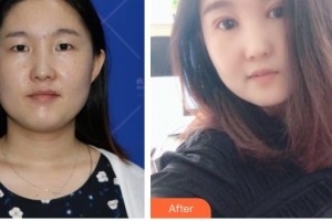 黑龍江藝星醫(yī)療美容醫(yī)院張鶴馨整形價格表附眼部綜合案例展示