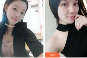 黑龍江中醫(yī)藥大學(xué)附屬第一醫(yī)院眼科孫河整形價格表附眼部綜合】案例展示