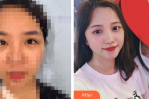 黑龍江中醫(yī)藥大學(xué)附屬第一醫(yī)院眼科樊曉瑞整形價格表附眼部綜合案例展示