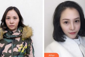 黑龍江省人民醫(yī)院整形美容中心劉忠梅整形價格表附紅藍(lán)光祛痘案例展示