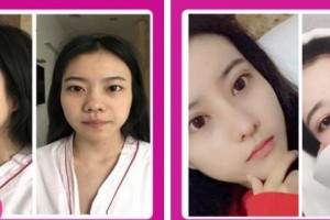 石家莊九朵醫(yī)療美容醫(yī)院沃貝貝整形價格表附切開雙眼皮案例展示
