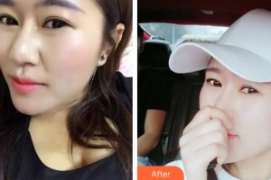 石家莊市婦產(chǎn)醫(yī)院醫(yī)療整形美容科高慧整形價格表附清潔祛痘案例展示