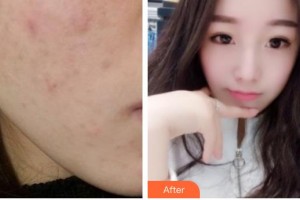 唐山美尚醫(yī)療美容診所張永新整形價格表附去痘印痘坑案例展示