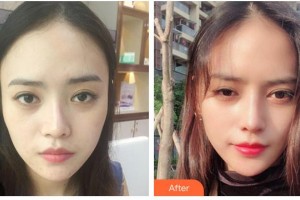 唐山開灤醫(yī)院整形美容中心李生來整形價格表附鼻部綜合案例展示