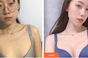 唐山金鳳凰美容整形醫(yī)院宋美璇整形價(jià)格表附自體脂肪隆胸案例展示