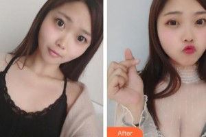 唐山金鳳凰美容整形醫(yī)院孫長生整形價格表附自體脂肪隆胸案例展示