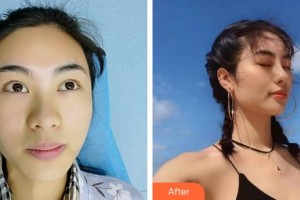 唐山美泉醫(yī)療美容診所吉云麗整形價(jià)格表附耳軟骨復(fù)合隆鼻案例展示