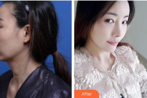 唐山金鳳凰美容整形醫(yī)院李春鵬整形價(jià)格表附鼻修復(fù)案例展示