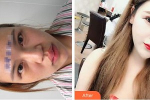 唐山煤醫(yī)整形美容醫(yī)院徐萬(wàn)群整形價(jià)格表附假體隆鼻案例展示