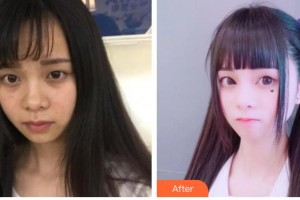 唐山煤醫(yī)整形美容醫(yī)院崔弘林整形價(jià)格表附切開(kāi)雙眼皮案例展示