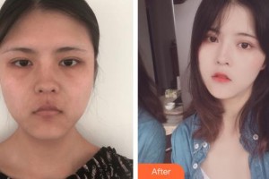 唐山金榮整形美容醫(yī)院劉雙飛整形價(jià)格表附埋線提升案例展示