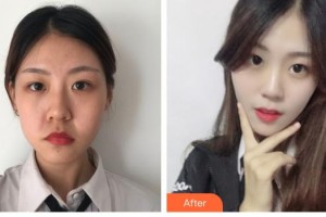 唐山煤醫(yī)整形美容醫(yī)院黃鎔碩整形價(jià)格表附埋線提升案例展示