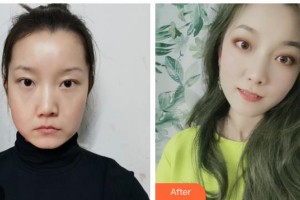 唐山煤醫(yī)整形美容醫(yī)院程守先整形價格表附埋線提升案例展示