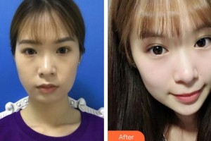 唐山煤醫(yī)整形美容醫(yī)院李承鍾整形價格表附埋線提升案例展示