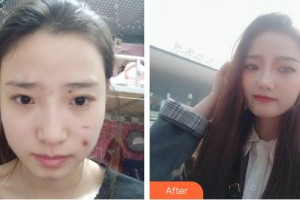 唐山煤醫(yī)整形美容醫(yī)院陶智潞整形價格表附去痘印痘坑案例展示