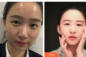 唐山市人民醫(yī)院燒傷整形科謝學(xué)峰整形價格表附激光祛斑案例展示