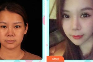 唐山市人民醫(yī)院燒傷整形科馮玉柱整形價格表附眼部綜合案例展示