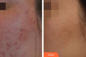 唐山市人民醫(yī)院燒傷整形科陳錚住院醫(yī)師整形價(jià)格表附清潔祛痘案例展示