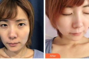 唐山市人民醫(yī)院燒傷整形科王永滿整形價格表附E光嫩膚案例展示