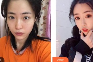 唐山聯(lián)合麗珍醫(yī)療美容門診部樸惠恩整形價(jià)格表附超聲提拉案例展示