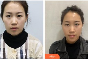 唐山祥云京城皮膚醫(yī)院張志坡整形價(jià)格表附埋線提升案例展示