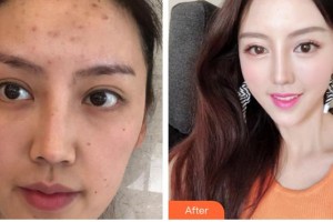 唐山煤醫(yī)整形美容醫(yī)院劉澤華整形價(jià)格表附埋線提升案例展示