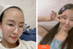 武漢思美妍醫(yī)療美容門診部李貴海整形價格表附植發(fā)案例展示