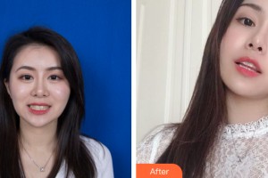 武漢綴美口腔門診部劉鵬整形價格表附牙齒矯正案例展示