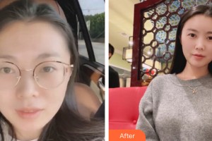 海口東湖醫(yī)學(xué)美容整形醫(yī)院李堅(jiān)整形價(jià)格表附自體脂肪填充案例展示