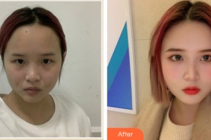 海口戴麗醫(yī)療美容診所沈熙慶整形價格表附皮膚美容案例展示