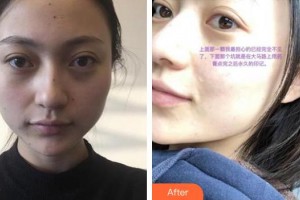 秦皇島紀(jì)輝整形美容醫(yī)院紀(jì)輝整形價(jià)格表附激光點(diǎn)痣案例展示