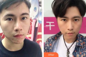 秦皇島紀(jì)輝整形美容醫(yī)院湯旭整形價(jià)格表附清潔祛痘案例展示