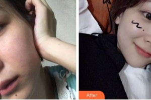 秦皇島紀(jì)輝整形美容醫(yī)院高明國(guó)整形價(jià)格表附光子嫩膚案例展示