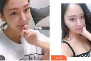 秦皇島巧致美容醫(yī)院王立英整形價(jià)格表附光子嫩膚案例展示