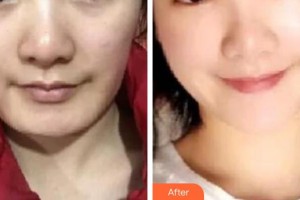 秦皇島巧致美容醫(yī)院張永國(guó)整形價(jià)格表附埋線提升案例展示